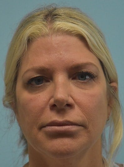 Before Image: Under Eye (Tear Trough) Filler - front