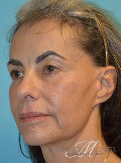 After Image: Under Eye (Tear Trough) Filler - left-front-oblique