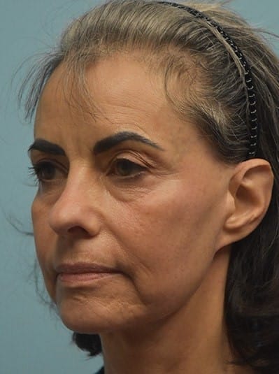 Before Image: Under Eye (Tear Trough) Filler - left-front-oblique