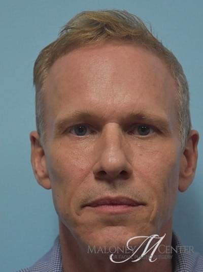 After Image: Under Eye (Tear Trough) Filler - front