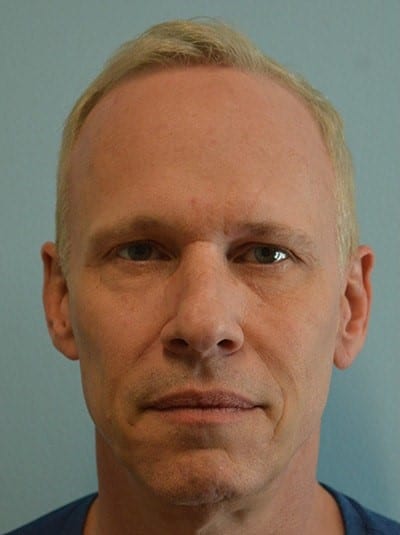 Before Image: Under Eye (Tear Trough) Filler - front