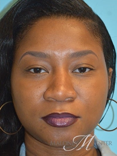 After Image: Under Eye (Tear Trough) Filler - front