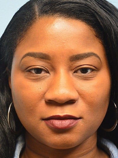 Before Image: Under Eye (Tear Trough) Filler - front