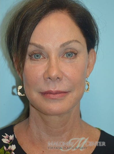 After Image: Vollure - front