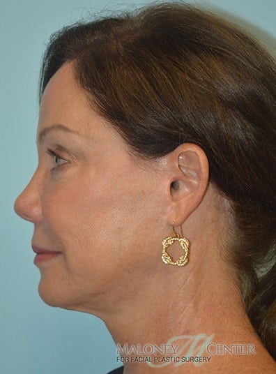After Image: Voluma XC - left-side