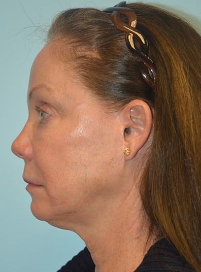 Before Image: Voluma XC - left-side