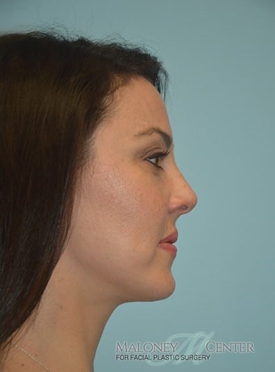 After Image: Voluma XC - right-side