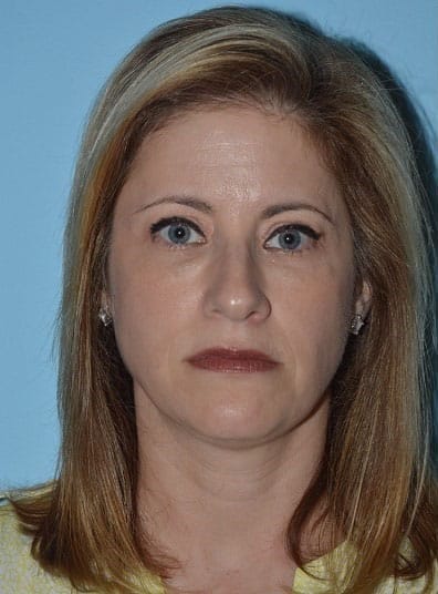 Before Image: Voluma XC - front