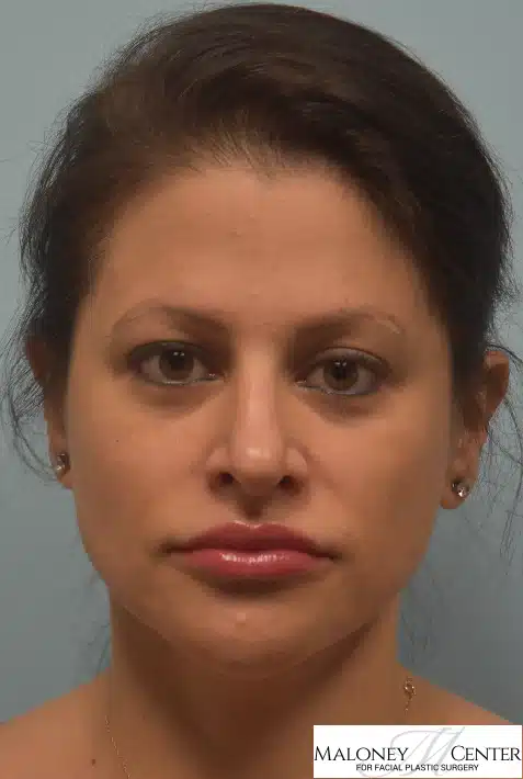 After Image: Buccal Fat Removal - front