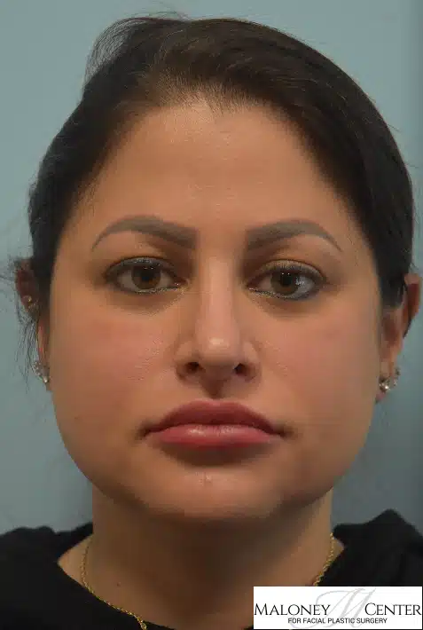 Before Image: Buccal Fat Removal - front