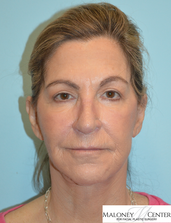 After Image: Buccal Fat Removal - front