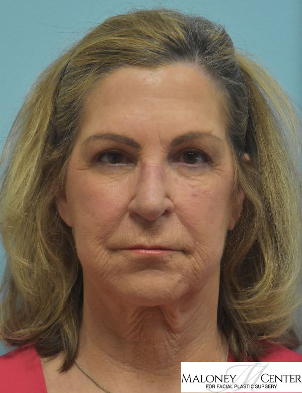 Before Image: Buccal Fat Removal - front