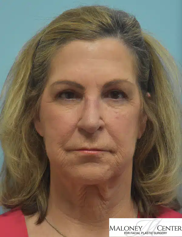 Before Image: Buccal Fat Removal - front