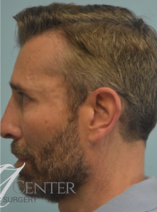 After Image: Rhinoplasty
