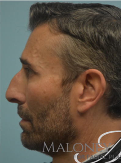 Before Image: Rhinoplasty - left-side