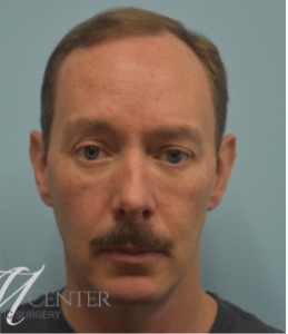 After Image: Blepharoplasty (eyelid)