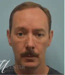 After Image: Blepharoplasty (eyelid) - front