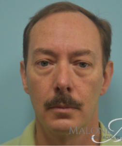 Before Image: Blepharoplasty (eyelid)
