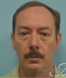 Before Image: Blepharoplasty (eyelid) - front