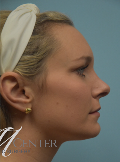 After Image: Rhinoplasty - right-side