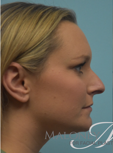Before Image: Rhinoplasty - right-side