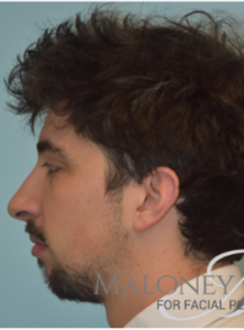 Before Image: Rhinoplasty