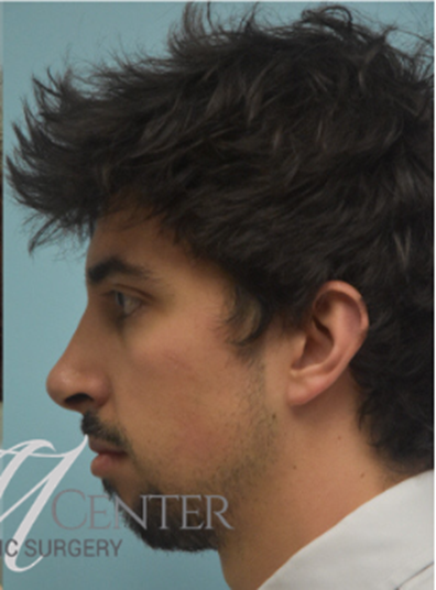 After Image: Rhinoplasty - left-side
