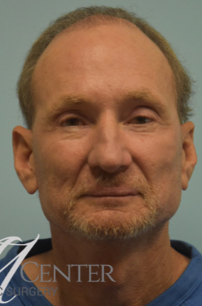 After Image: Blepharoplasty (eyelid) - front