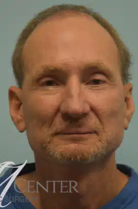 After Image: Blepharoplasty (eyelid) - front