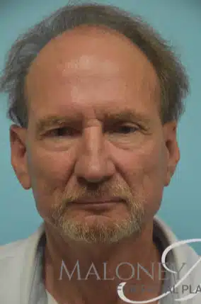 Before Image: Blepharoplasty (eyelid) - front