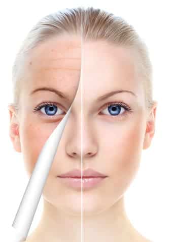Facial Peel e1463664953717 Facial Peel e1463664953717