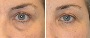 tear trough filler tear trough filler