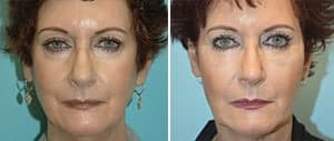 tear trough filler 2 tear trough filler 2