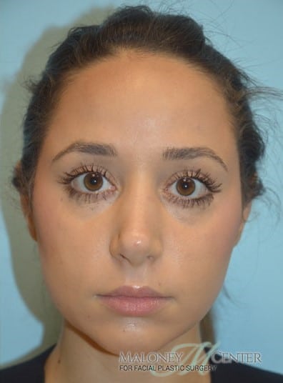 After Image: Rhinoplasty - front