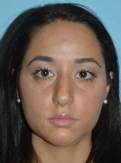 Before Image: Rhinoplasty - front