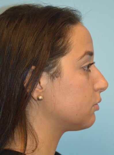Before Image: Rhinoplasty - right-side