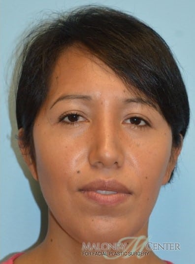 Before Image: Rhinoplasty - front